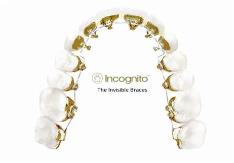 Lingual braces