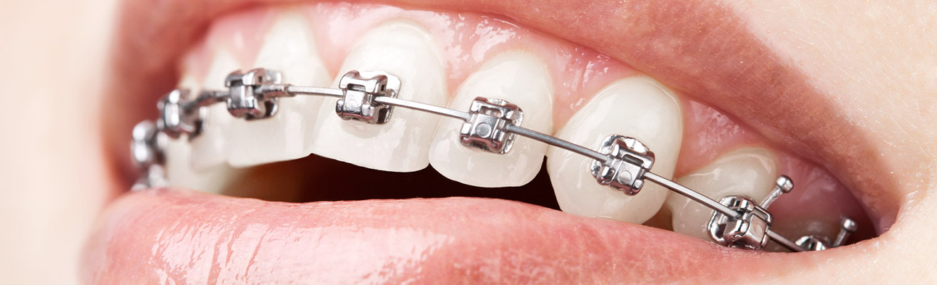 Metal braces