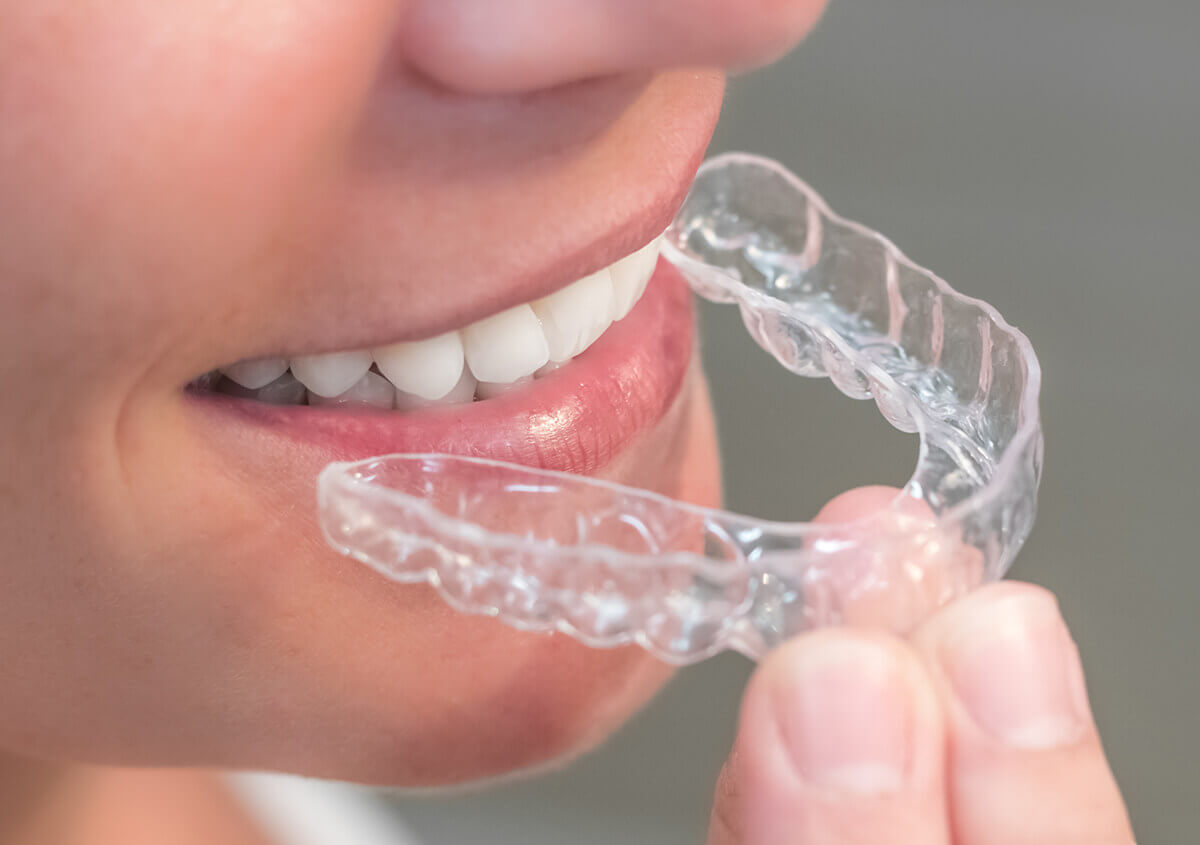 Retainers